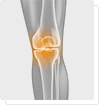  la douleur dans les articulations du genou