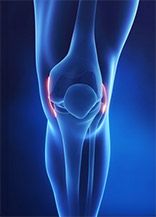 l'arthrite du genou